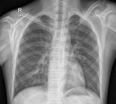 正常胸腔 X 光