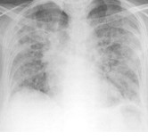 肺炎胸腔 X 光